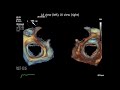 3D TEE of a Normal Mitral Valve