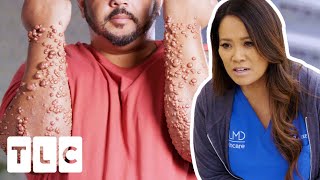 Dr Lee Has NEVER Seen A Case Of Cholesterol Bumps THIS Bad | Dr. Pimple Popper