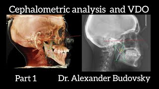 How to Determine Vertical Dimension of Occlusion (VDO, OVD). Cephalometric analysis. Part 1