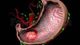 Gastric MALT Lymphoma - Animated Atlas of Breast and Gastric Cancer