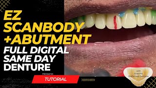 Same Day Digital Denture - (most efficient technique)