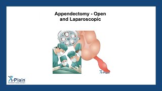 Appendectomy - Open and Laparoscopic