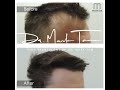 Restored Receding Hairline, 2 Hair Transplants. Hair Transplant By Dr Mark Tam, Harley Street London