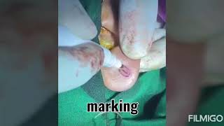Torn Ear Lobe Repair by Punch Excision