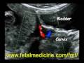 Fetal Medicine Foundation - Preeclampsia