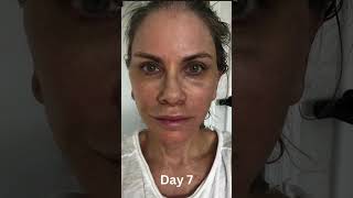 6 WEEK COMPLETE TRANSFORMATION! Day-by-Day Facelift Progression