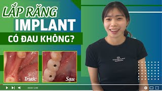 LẮP 2 RĂNG IMPLANT RĂNG HÀM