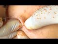 How To Remove Blackheads And Whiteheads On Face Easy #30 ✦ Dr Laelia ✦