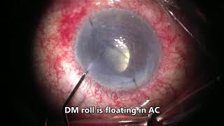 Management of complete DM detachment  after DMEK