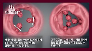 통증 없고 회복 빠른 간단한 치질수술, 바나나클립!