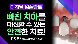 디지털 임플란트, 환자의 치아를 안전하게 도와 줄 치료 !! [ 부산MBC 메디컬다큐365 ] 230424