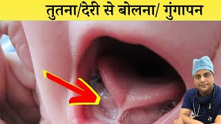 छोटे बच्चे देर से क्यों बोलते है ? गूंगे बच्चे के लक्षण ? Autism Symptoms Or Delayed Speech Part - 1