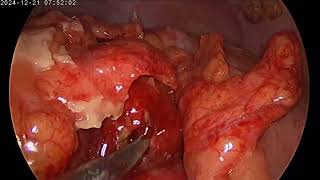 LAP SIGMOID DIVERTICULAR PERFORATION REPAIR, OMENTOPEXY , APPENDECTOMY