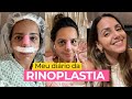 MINHA RINOPLASTIA: pós-operatório doeu? Meu diário de 12 dias com ANTES e DEPOIS | Prefiro Viajar