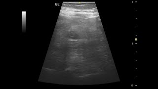 Ultrasound showing acute appendicitis with abscess formation