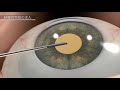 白内障手術の流れをcgで解説【cataract surgery cg video 白内障手術cgビデオ】