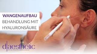 Wangenaufbau | Behandlung mit Hyaluronsäure | d-aesthetic