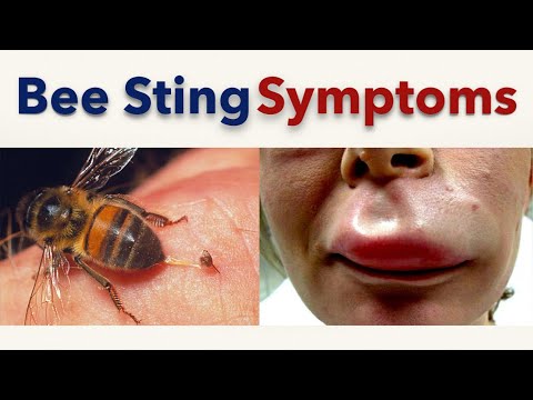 Bee Sting Symptoms Bee Sting Symptoms