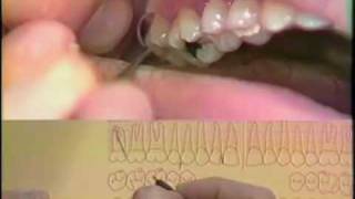 Periodontal Charting Procedure