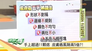 手上超過11顆痣「皮膚癌」風險高5倍？皮膚癌五不辨識法！健康2.0 20161105 (3/4)