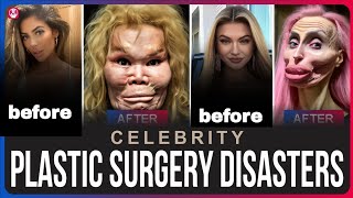 Top 5 Worst Celebrity Plastic Surgery Disasters