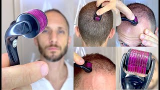 How I Use DermaRoller Microneedling for Hair Growth and To Solve my Baldness and Hair Loss