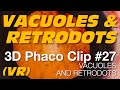 3D Phaco Clip #27 - Vacuoles and Retrodots (VR Headset version)