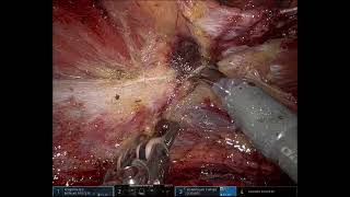 Large Morgagni hernia - rTAPP repair