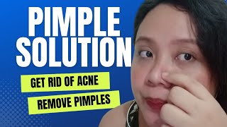 GAMOT SA ACNE OR PIMPLE-  MIRACLE PRODUCT ||  Epektibong Solusyon sa Pimple, Acne