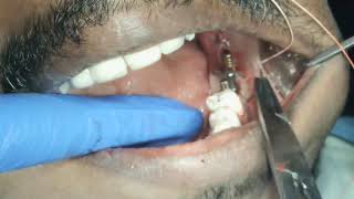 Live - grossly decayed molar + rootstumps/ 38 impaction - immediate loading basal implants