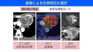 希少がんに対するIVR　曽根 美雪　～主に医療者向け～ 【国立がん研究センター希少がんセンター】