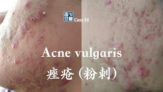 Acne vulgaris 痤疮 (粉刺), Treat Acne in Natural and Safe Way.