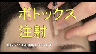 眉間ボトックス注射【閲覧注意】Botox Vista before and after video