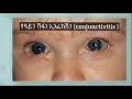 የዓይን መቅላት ህመም መንስዔዎች causes of red eye