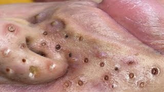 Loan Nguyen Acne Treatment 51x