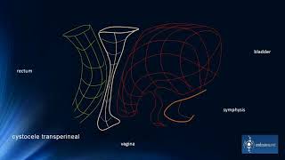 3D Assessment of the Pelvic Floor