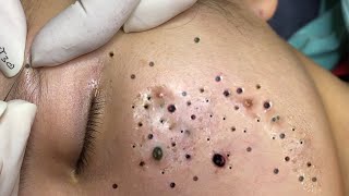 Big Cystic Acne Blackheads Extraction Blackheads \u0026 Milia, Whiteheads Removal Pimple Popping # 1624