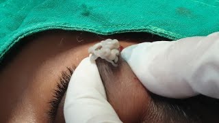 Sebaceous cyst on eyebrow