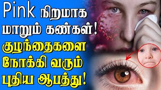 Conjunctivitis  கைக்குழந்தைகள் மற்றும் குழந்தைகளை தாக்கும் புதிய நோய்?? அவசர எச்சரிக்கை!!!!