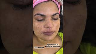 Hydra facial for pigmentation it help to remove dark spots gives hydration to skin