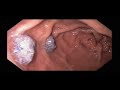 gastro gastric fistula and involuted gastro jejunal anastomosis after gastric bypass