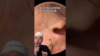 INFECTED EARRING REMOVAL!😱 (follow for more💗) #beauty #skincare #beautytips #acne #skincareroutine