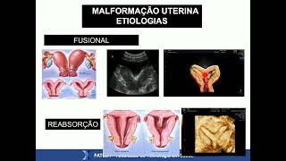 Aula Teórica Ultrassonografia 3D e 4D Aplicações em Ginecologia - Parte 01 - D.I.U, Malformações