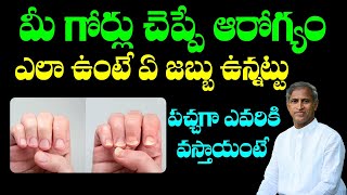 గోర్లు ఇలా ఉంటె మీకు ఈ సమస్య ఉందని అర్ధం | Nail Infections | Manthena Satyanarayana Raju