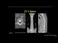 Neuroradiology spine lesions - Case 3 - overview - Choose your own adventure