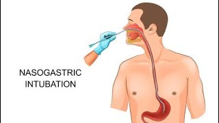 انبوبه الأنف المعديه nasogastric tube