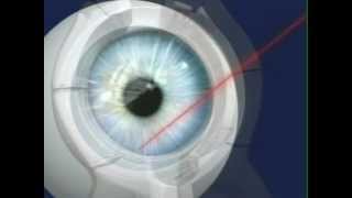 מהו הליך Intralase, השנים הראשונות של LASIK בחולים המחפשים עצמאות משקפיים?