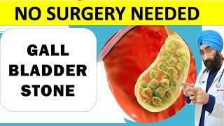 No Pain No Surgery Needed | Asymptomatic Gall Bladder Stone Treatment | Dr.Education