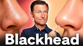 The #1 Remedy to Remove Blackheads Permanently