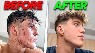 How I Cleared My Acne